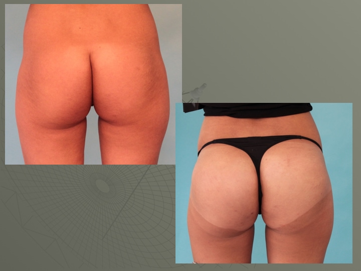 Plastie de fesses par implants ( 300ml)